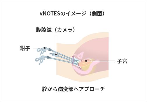 vNOTESのイメージ（側面） 膣から病変部へアプローチ