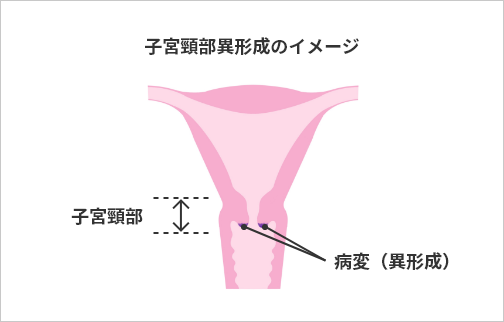 子宮頸部異形成のイメージ