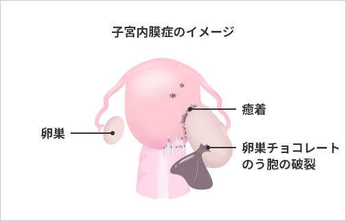 子宮内膜症のイメージ