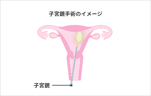 子宮鏡手術のイメージ