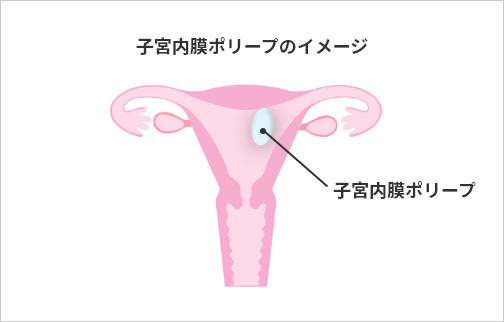 子宮内膜ポリープのイメージ