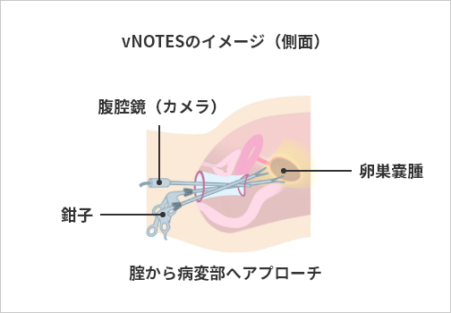 vNOTESのイメージ（側面） 腟から病変部へアプローチ