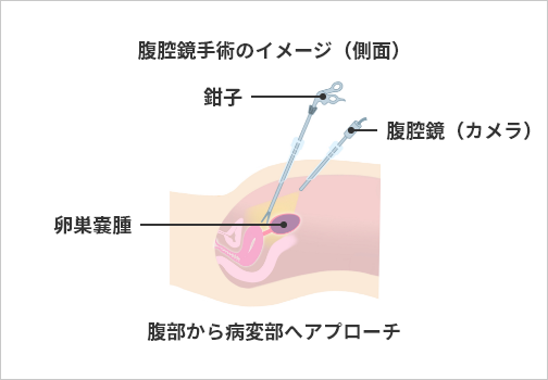 腹腔鏡手術のイメージ（側面） 腹部から病変部へアプローチ