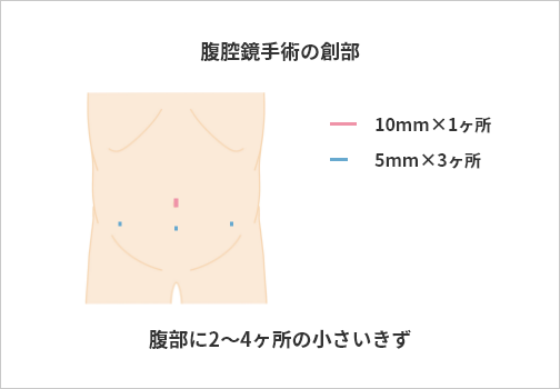 腹腔鏡手術の創部 腹部に2～4ヶ所の小さいきず
