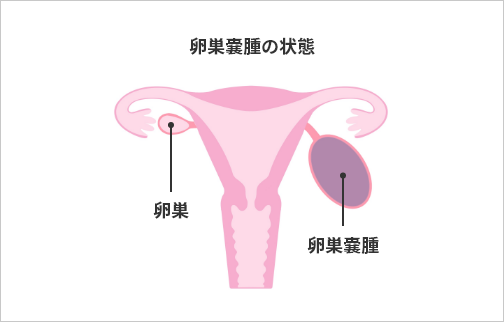 卵巣嚢腫の状態