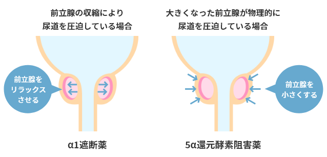前立腺の収縮により尿道を圧迫している場合：α1遮断薬（前立腺をリラックスさせる）、大きくなった前立腺が物理的に尿道を圧迫している場合：5α還元酵素阻害薬（前立腺を小さくする）