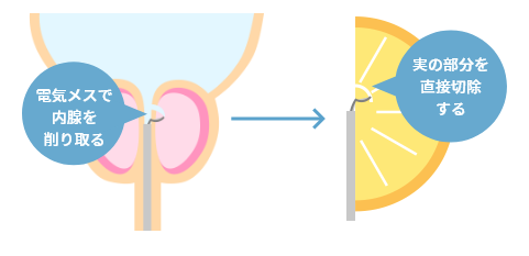 電気メスで内腺を削り取る、実の部分を直接切除する