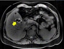 MRIでとらえた胆嚢結石（胆石）